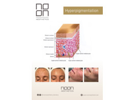 NOON A4 PANCART HYPERPIGMENTATION